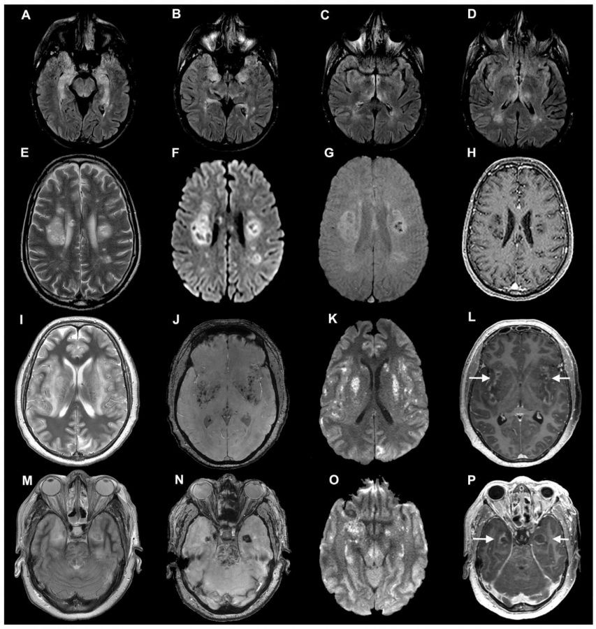 Brain scans from July 2020 of coronavirus patients showing neurological damage, as serious as nerve damage in some cases. (Oxford University Press)