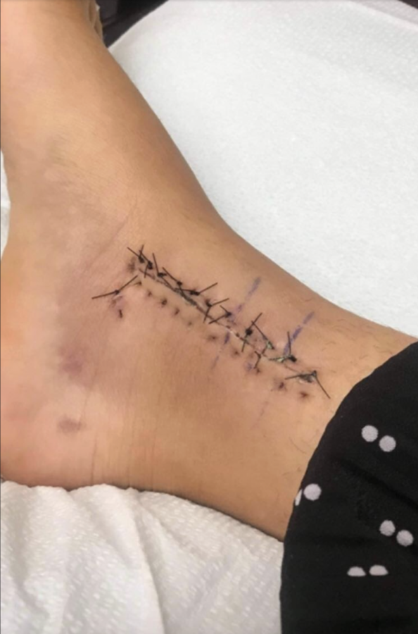 Student Shabnam Abdulnasir snapped her ankle during lunch while playing soccer, resulting in 16 stitches. 
(Shabnam Abdulnasir)